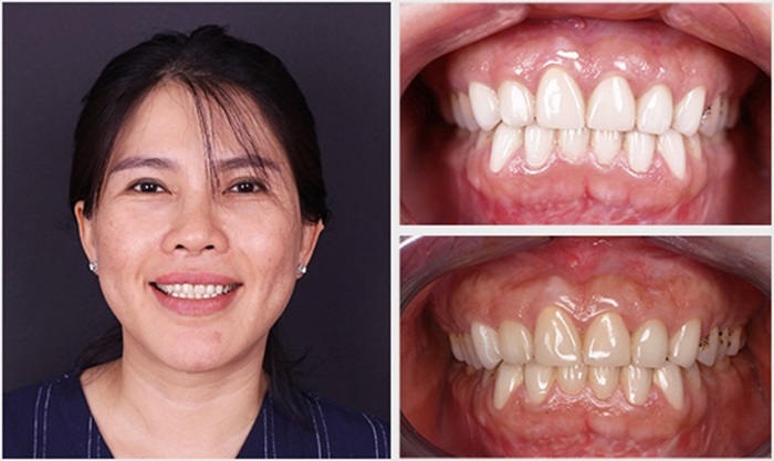 Cho con bú có tẩy trắng răng được không? - Thực hư và lời khuyên