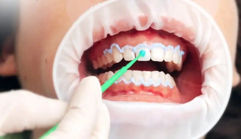 Cho con bú có tẩy trắng răng được không? - Thực hư và lời khuyên