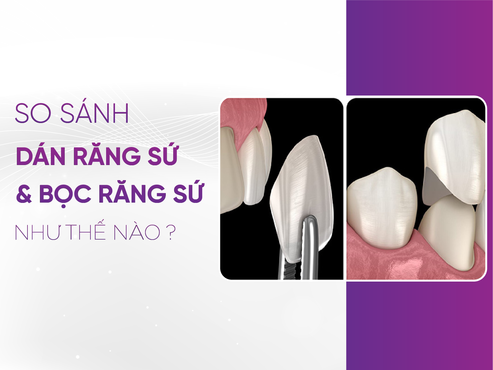 Dán Răng Sứ Hay Bọc Răng Sứ? Ưu Điểm Và Nhược Điểm Cần Biết