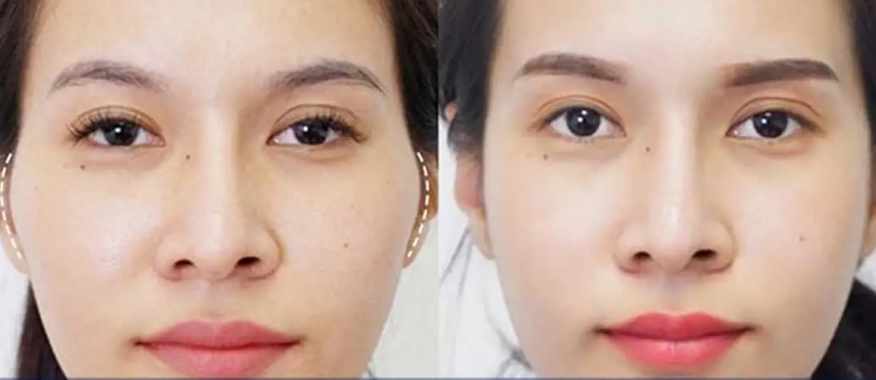 Gò Má Cao - Đặc Điểm Thẩm Mỹ Và Ý Nghĩa Sâu Sắc Đằng Sau