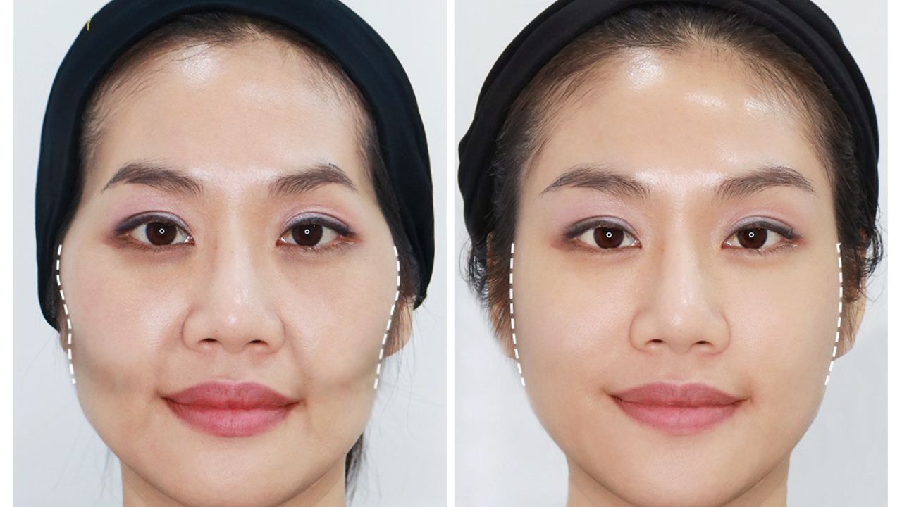Gò Má Cao - Đặc Điểm Thẩm Mỹ Và Ý Nghĩa Sâu Sắc Đằng Sau