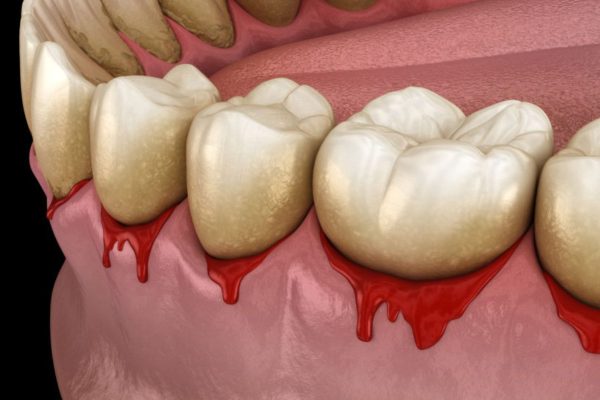 Hôi Miệng Có Lây Không? - Sự Thật, Phòng Ngừa Hiệu Quả