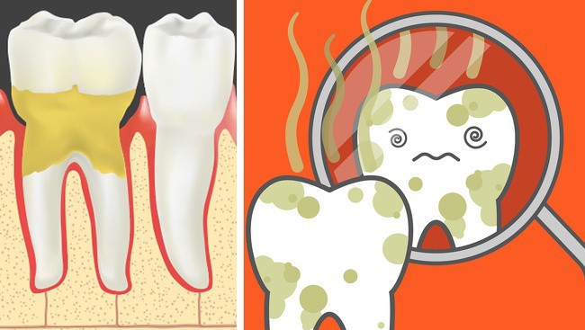 Hôi Miệng Có Lây Không? - Sự Thật, Phòng Ngừa Hiệu Quả