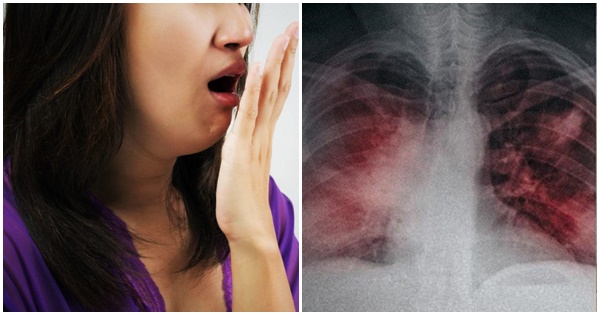 Hôi Miệng Có Lây Không? - Sự Thật, Phòng Ngừa Hiệu Quả