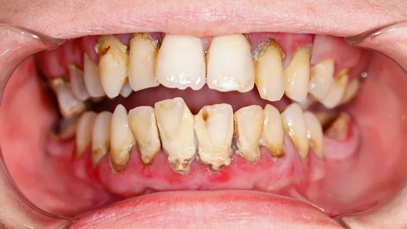 Hôi Miệng Có Lây Không? - Sự Thật, Phòng Ngừa Hiệu Quả