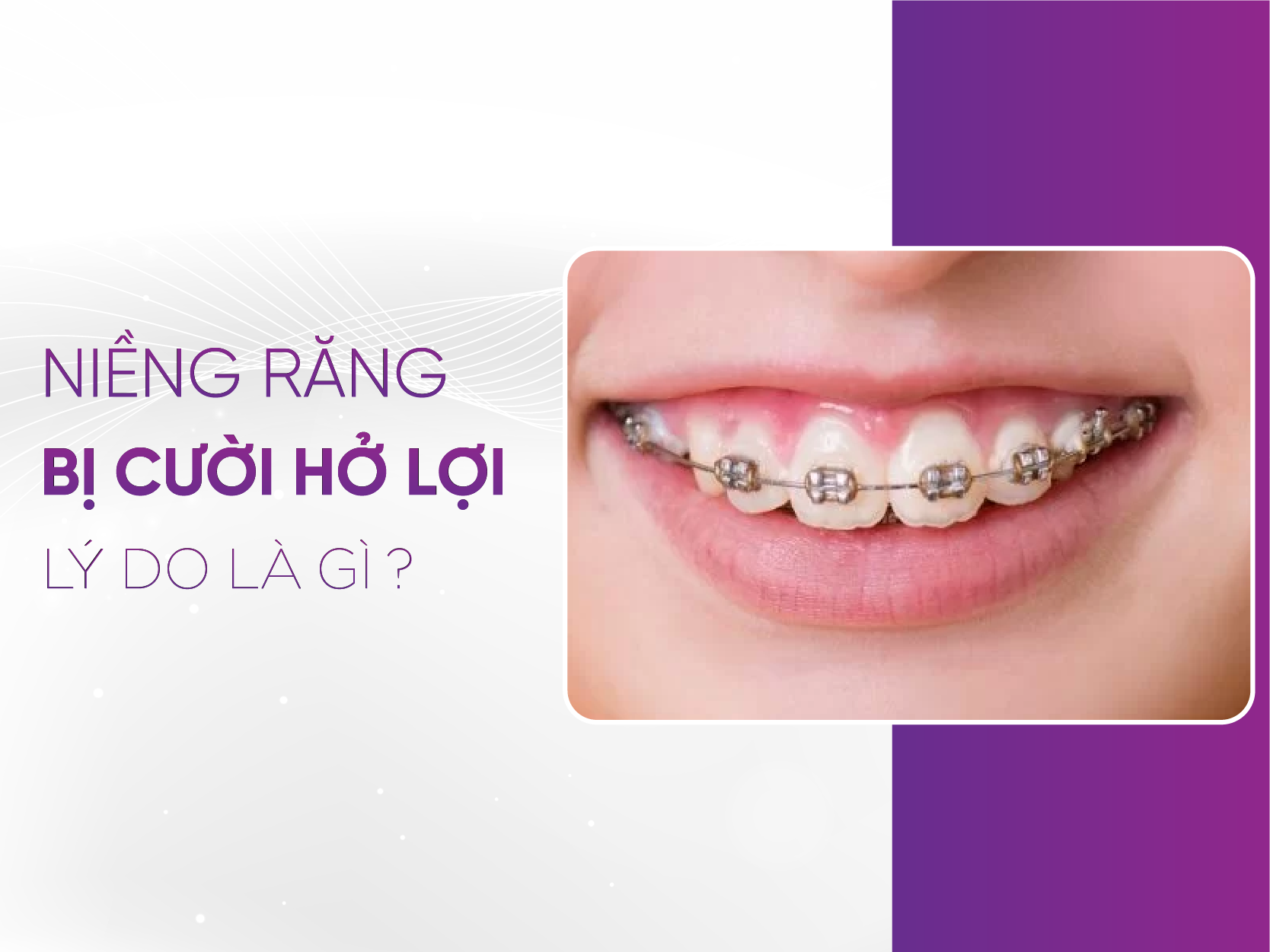 Niềng Răng Xong Bị Cười Hở Lợi - 5 Nguyên Nhân Và Giải Pháp Từ Chuyên Gia