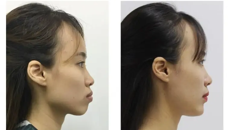 Niềng Răng Xong Bị Cười Hở Lợi - Tìm Hiểu Nguyên Nhân và Giải Pháp Từ Chuyên Gia