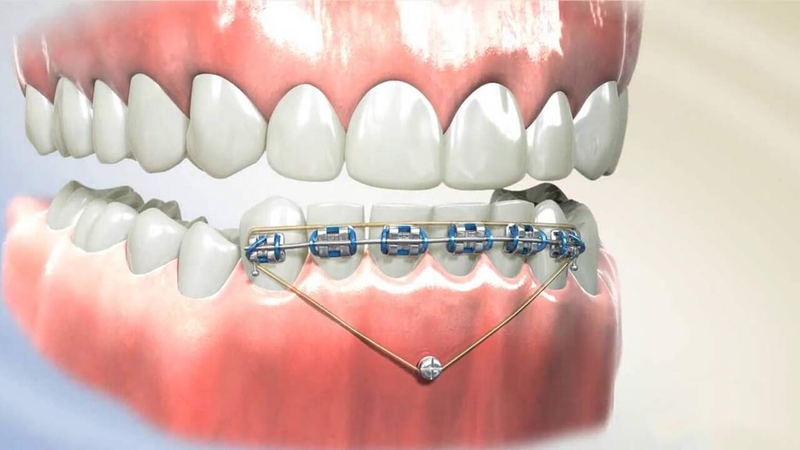 Niềng Răng Xong Bị Cười Hở Lợi - Tìm Hiểu Nguyên Nhân và Giải Pháp Từ Chuyên Gia