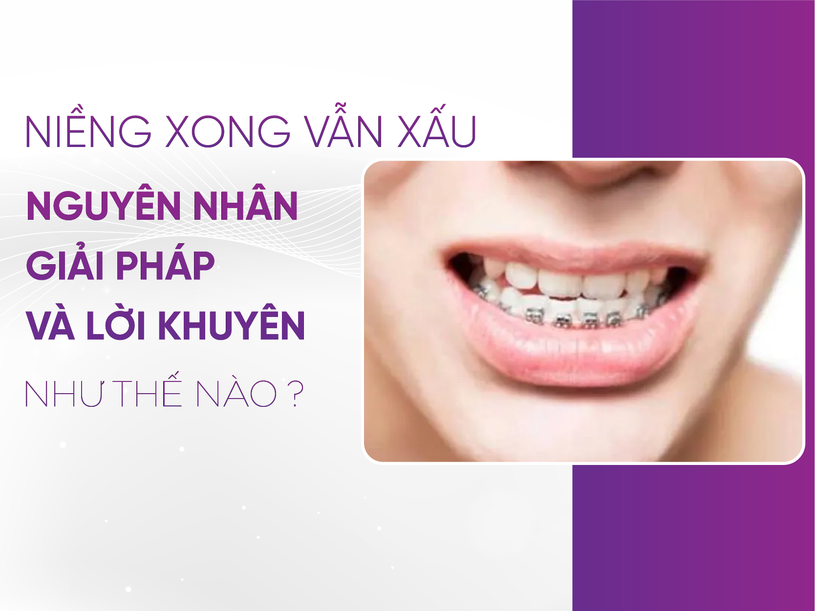 Niềng Răng Xong Vẫn Xấu - Khám Phá Nguyên Nhân Và Giải Pháp Thực Tế