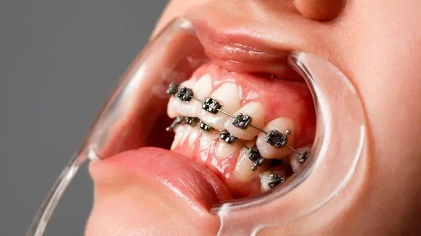 Niềng Răng Xong Vẫn Xấu - Khám Phá Nguyên Nhân và Giải Pháp Thực Tế