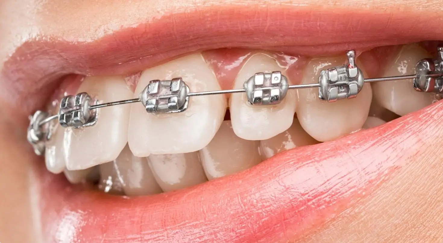 Niềng Răng Xong Vẫn Xấu - Khám Phá Nguyên Nhân và Giải Pháp Thực Tế