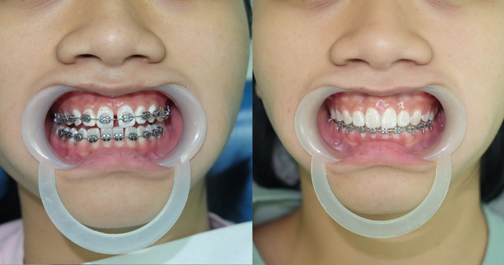 Niềng Răng Xong Vẫn Xấu - Khám Phá Nguyên Nhân và Giải Pháp Thực Tế