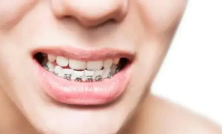 Niềng răng xong vẫn xấu? 5 nguyên nhân phổ biến