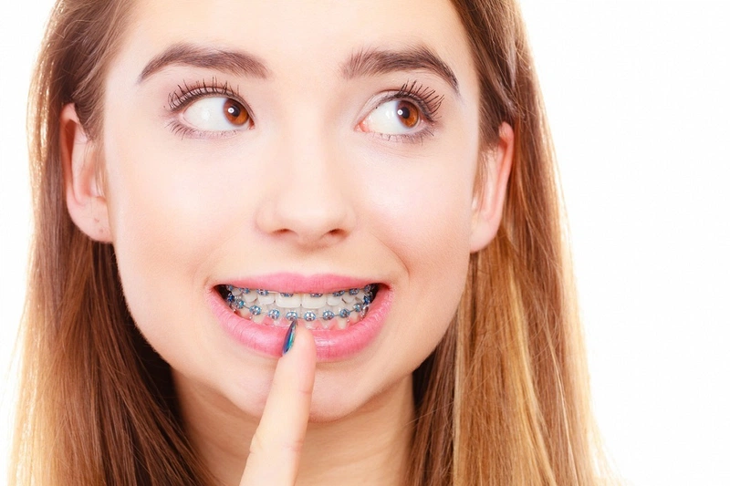 Niềng Răng Xong Vẫn Xấu - Khám Phá Nguyên Nhân và Giải Pháp Thực Tế