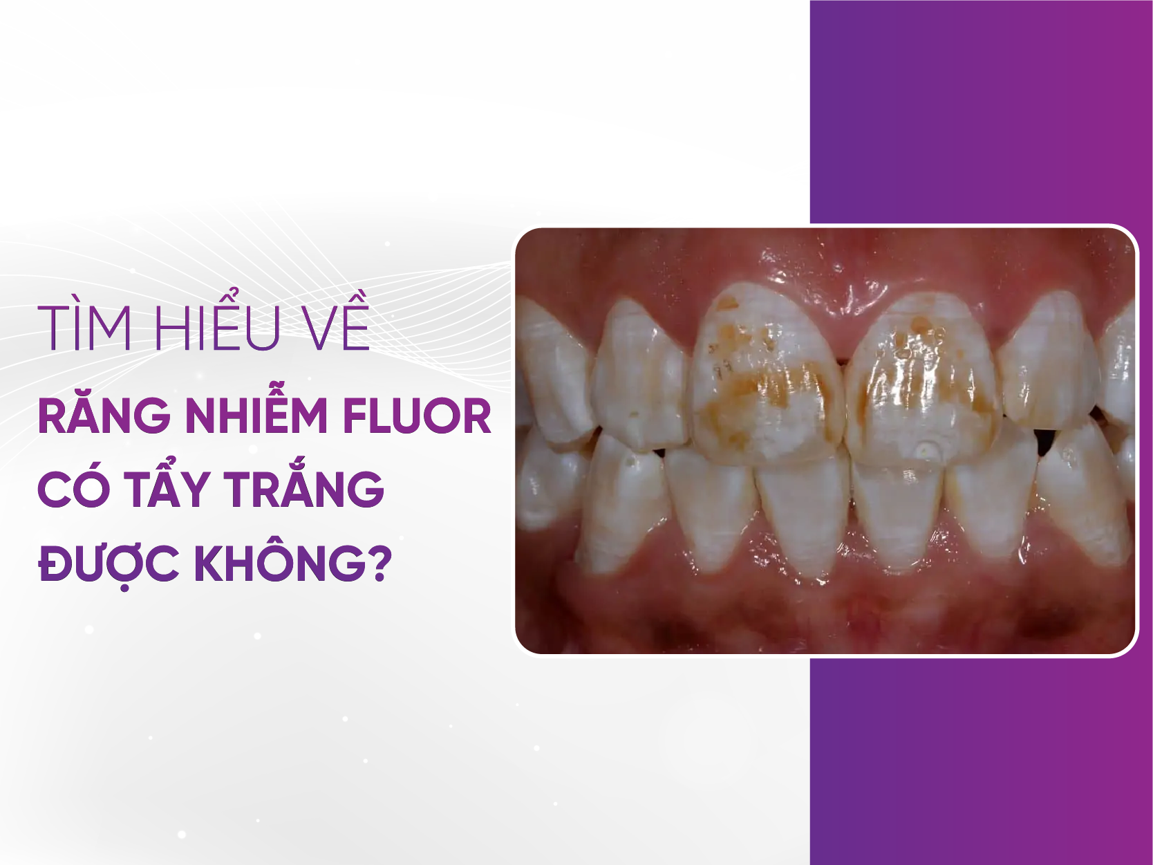 Răng Bị Nhiễm Fluor Có Tẩy Trắng Được Không? - Bật Mí Bí Mật