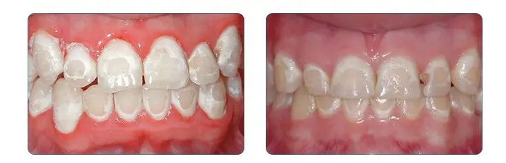 Răng Bị Nhiễm Fluor Có Tẩy Trắng Được Không? - Bật mí bí mật