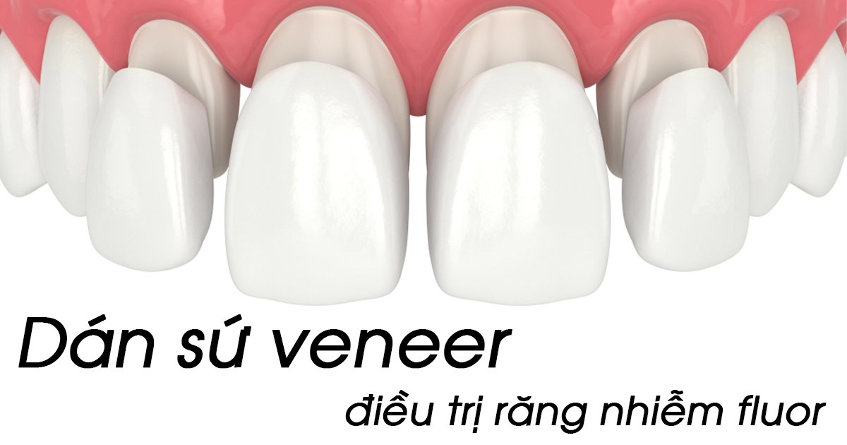 Răng Bị Nhiễm Fluor Có Tẩy Trắng Được Không? - Bật mí bí mật