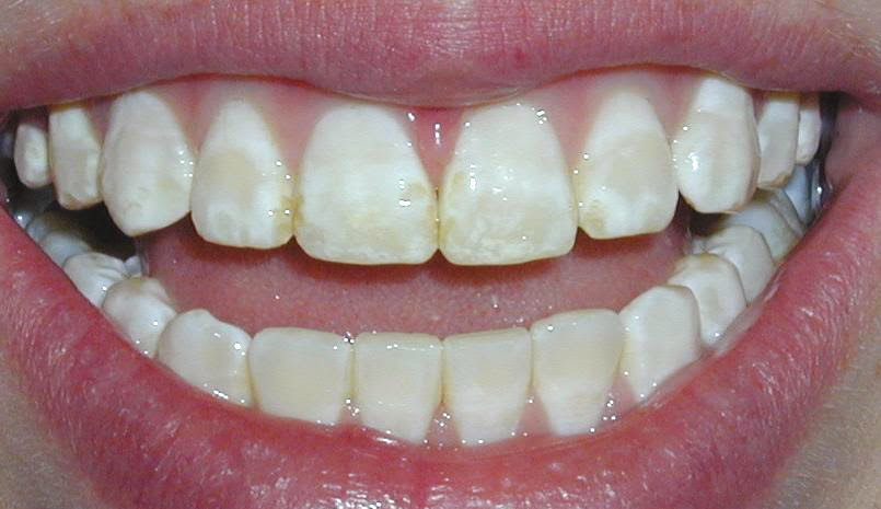 Răng Bị Nhiễm Fluor Có Tẩy Trắng Được Không? - Bật mí bí mật