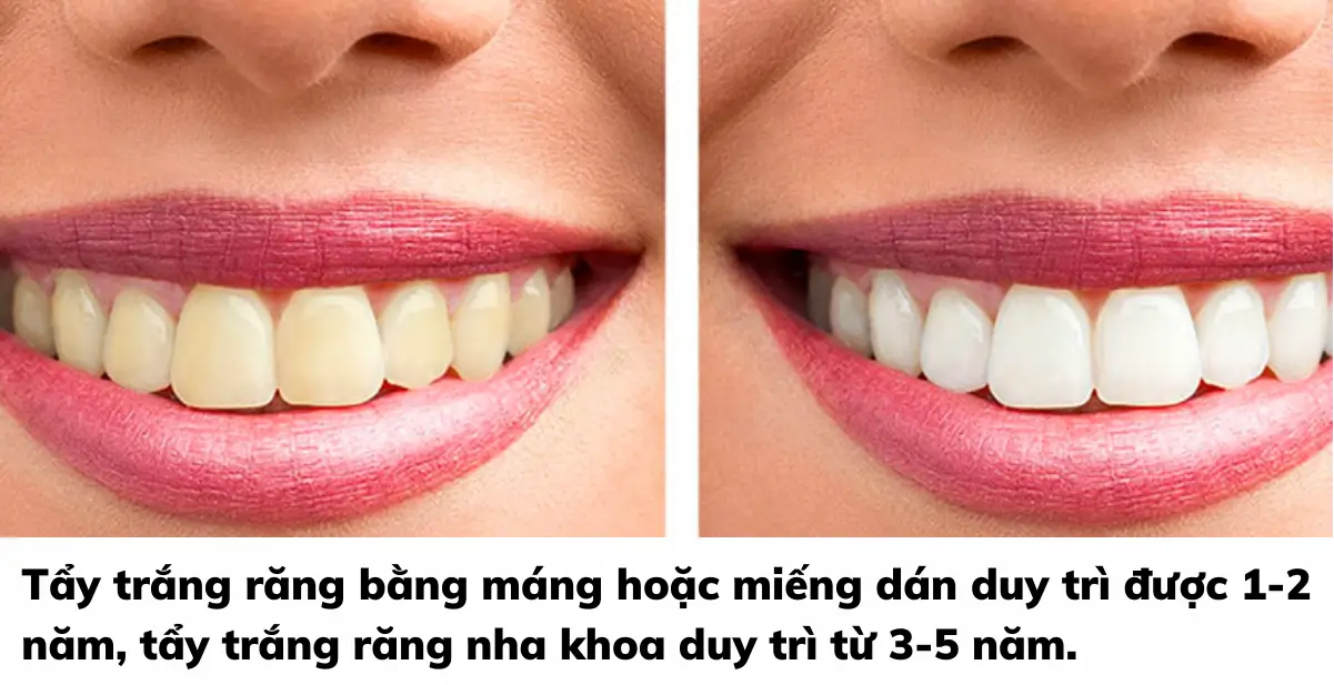 Tẩy Trắng Răng Tại Nhà Bằng Máng - Bí Quyết Nụ Cười Rạng Rỡ