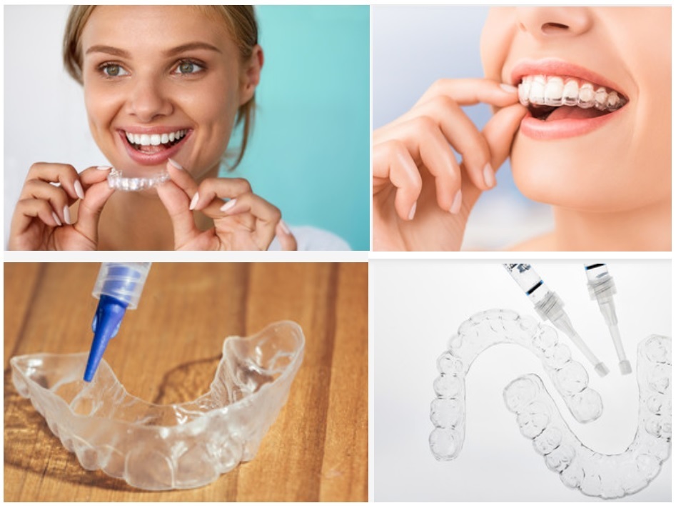 Tẩy Trắng Răng Tại Nhà Bằng Máng - Bí Quyết Nụ Cười Rạng Rỡ