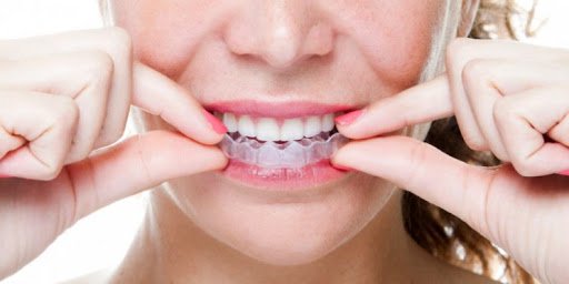 Tẩy Trắng Răng Tại Nhà Bằng Máng - Bí Quyết Nụ Cười Rạng Rỡ