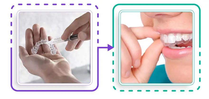 Tẩy Trắng Răng Tại Nhà Bằng Máng - Bí Quyết Nụ Cười Rạng Rỡ