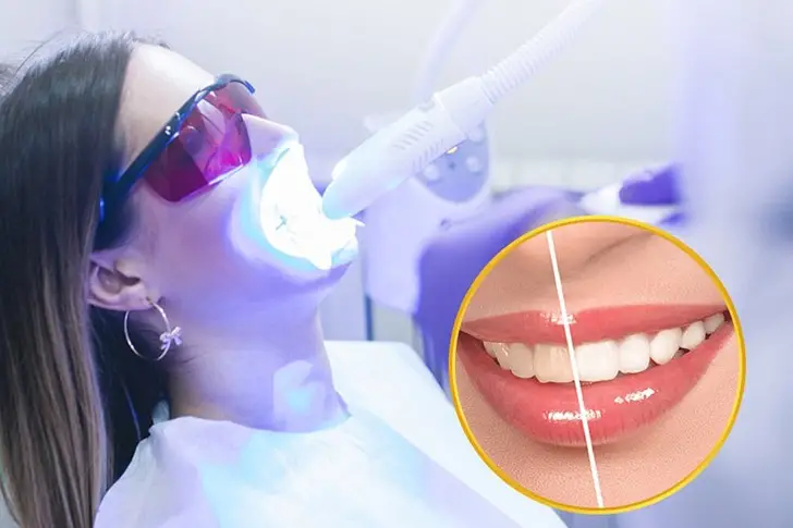 Tẩy Trắng Răng Tại Nhà Bằng Máng - Bí Quyết Nụ Cười Rạng Rỡ