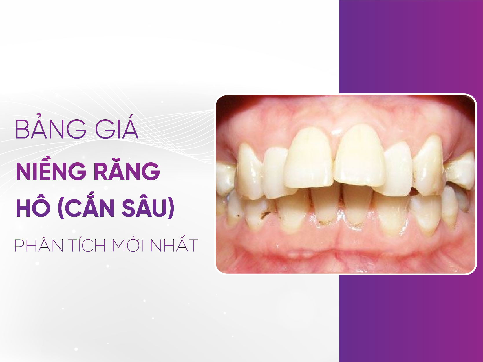 Bảng Giá Niềng Răng Hô - Chi Phí Và Lựa Chọn Hiệu Quả 2025