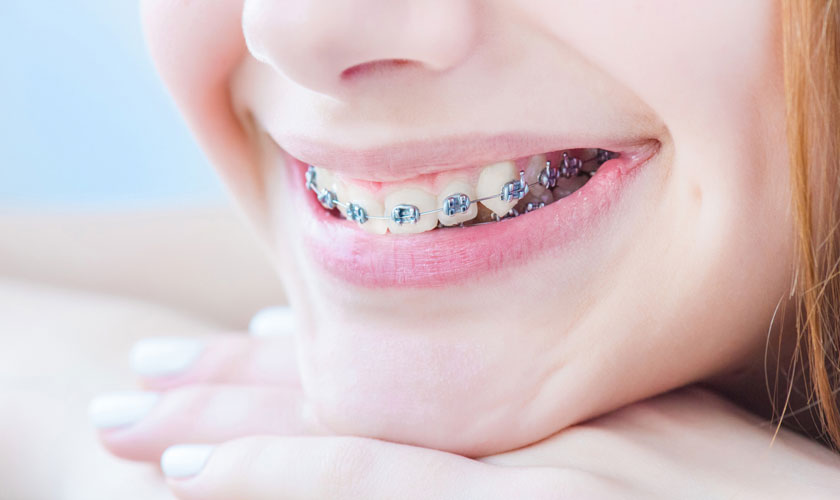 Bảng giá niềng răng hô - Khám phá chi phí và lựa chọn hiệu quả cho nụ cười hoàn hảo