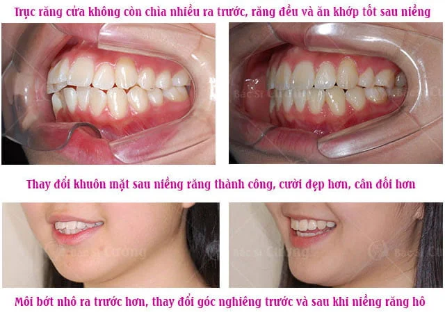 Bảng giá niềng răng hô - Khám phá chi phí và lựa chọn hiệu quả cho nụ cười hoàn hảo