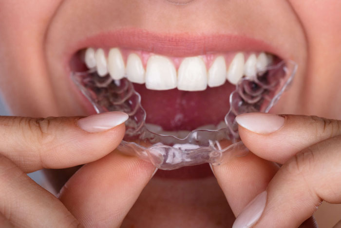 Máng Chống Nghiến - Giải Pháp Cho Giấc Ngủ Ngon Và Nụ Cười Khỏe