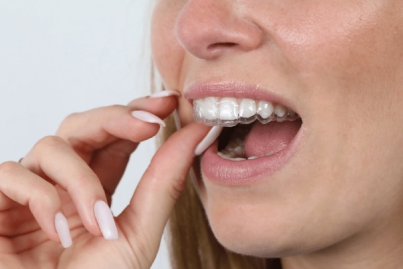 Máng Chống Nghiến - Giải Pháp Cho Giấc Ngủ Ngon Và Nụ Cười Khỏe
