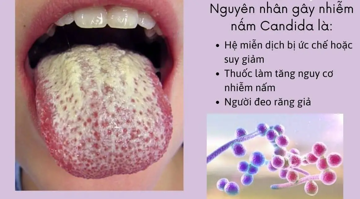 Nấm miệng là gì - Hiểu rõ để bảo vệ sức khỏe răng miệng Nấm Miệng Là Gì - Hiểu Rõ Để Bảo Vệ Sức Khỏe Răng Miệng