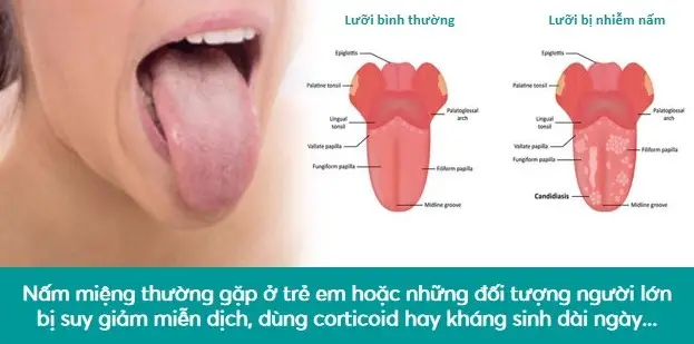 Nấm miệng là gì - Hiểu rõ để bảo vệ sức khỏe răng miệng Nấm Miệng Là Gì - Hiểu Rõ Để Bảo Vệ Sức Khỏe Răng Miệng