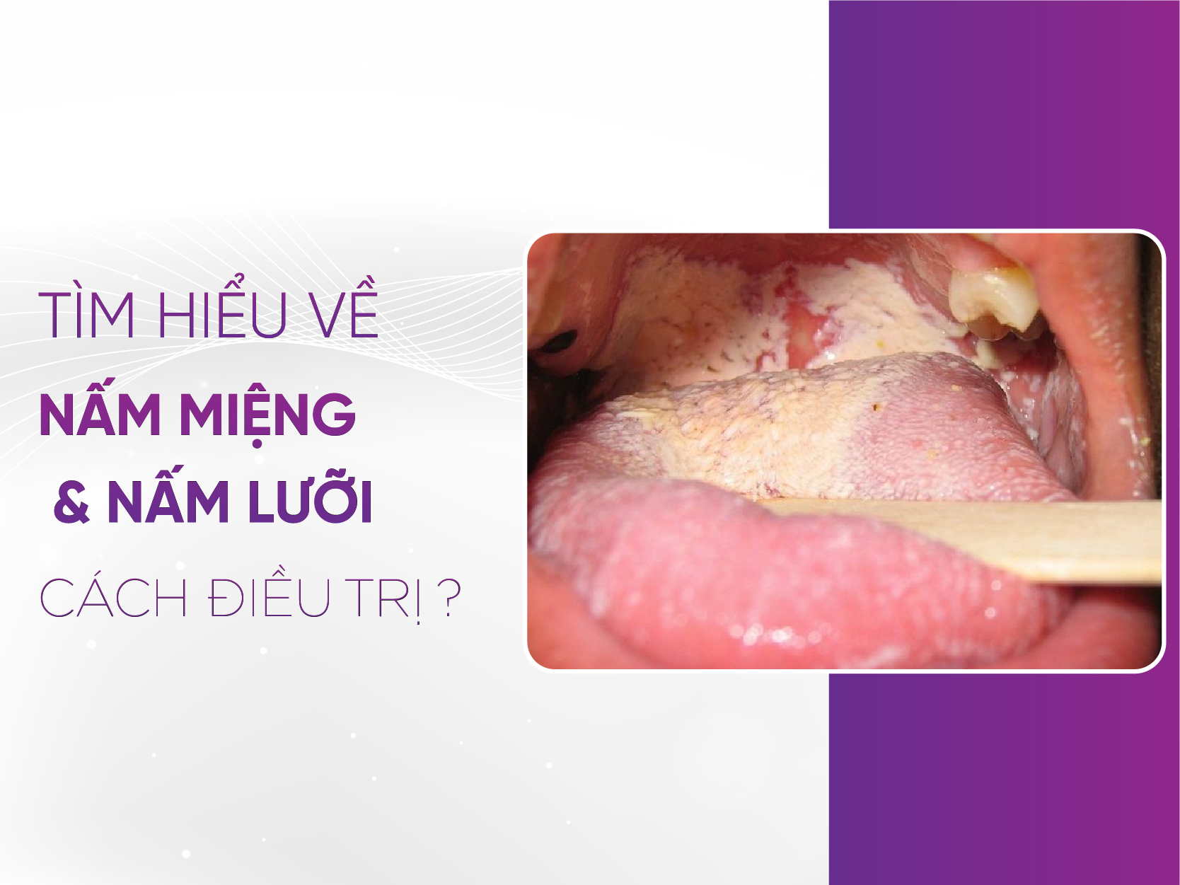 Nấm Miệng Là Gì - Hiểu Rõ Để Bảo Vệ Sức Khỏe Răng Miệng