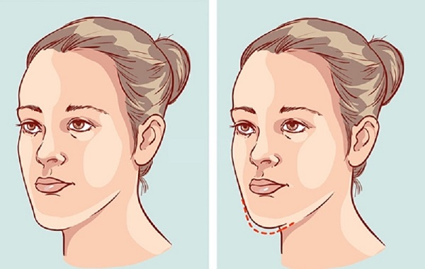 Niềng Răng Hóp Má - Bí Quyết Giải Pháp Cho Khuôn Mặt