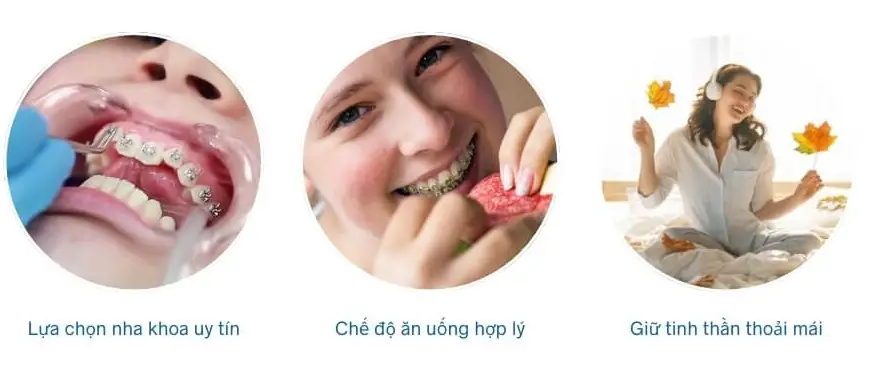 Niềng Răng Hóp Má - Bí Quyết Giải Pháp Cho Khuôn Mặt