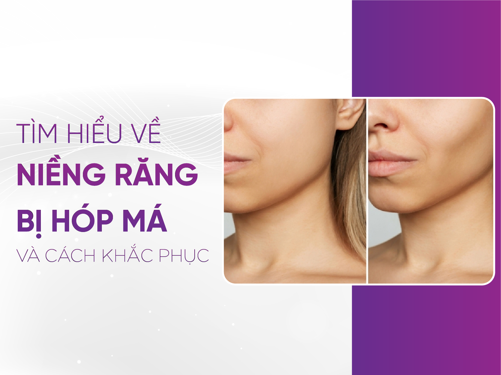 Niềng Răng Hóp Má - Bí Quyết &Amp; Giải Pháp Cho Khuôn Mặt 2025