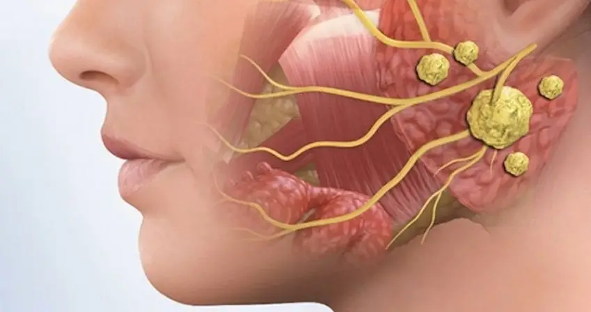 Nước Miếng Có Mùi Hôi - Không Chỉ Là Hơi Thở Mà Là Dấu Hiệu Cảnh Báo Sức Khỏe