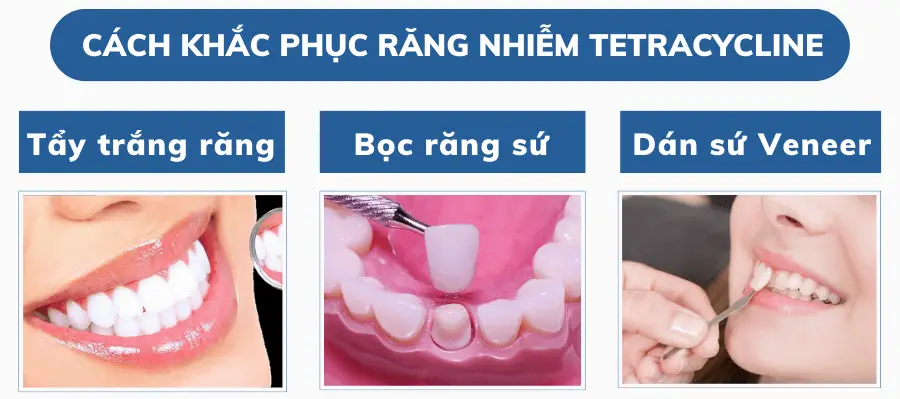Răng Nhiễm Tetra Có Tẩy Trắng Được Không - Giải Pháp Lời Khuyên