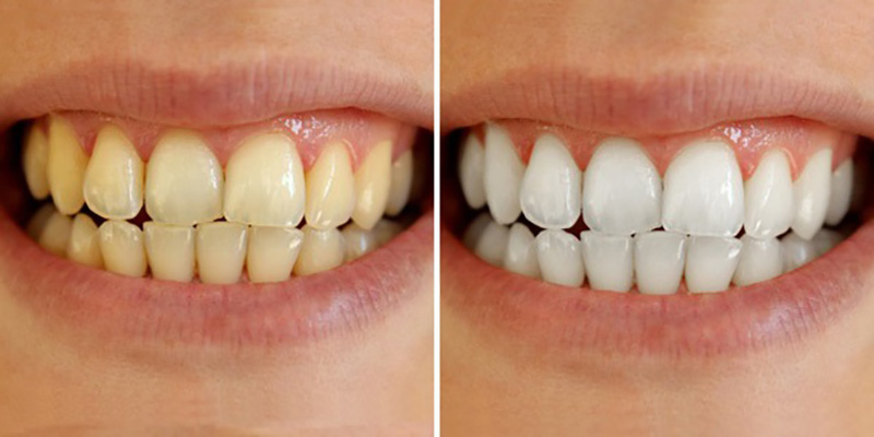 Răng Nhiễm Tetra Có Tẩy Trắng Được Không - Giải Pháp Lời Khuyên