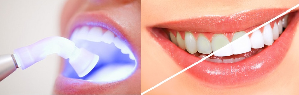 Răng Nhiễm Tetra Có Tẩy Trắng Được Không - Giải Pháp Lời Khuyên