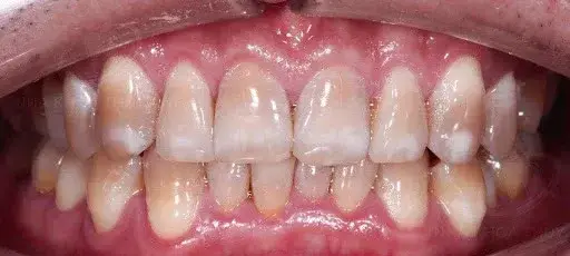 Răng Nhiễm Tetra Có Tẩy Trắng Được Không - Giải Pháp Lời Khuyên