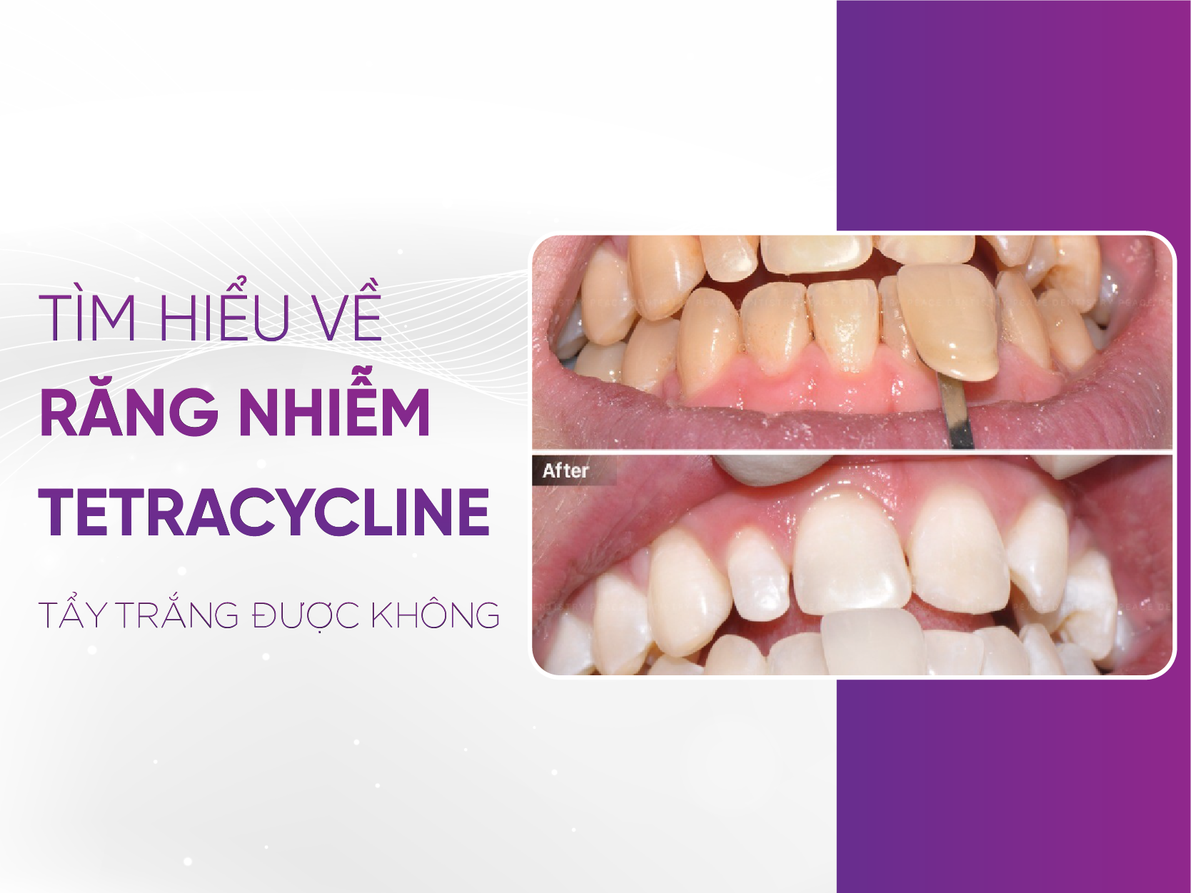 Răng Nhiễm Tetra Có Tẩy Trắng Được Không 2025