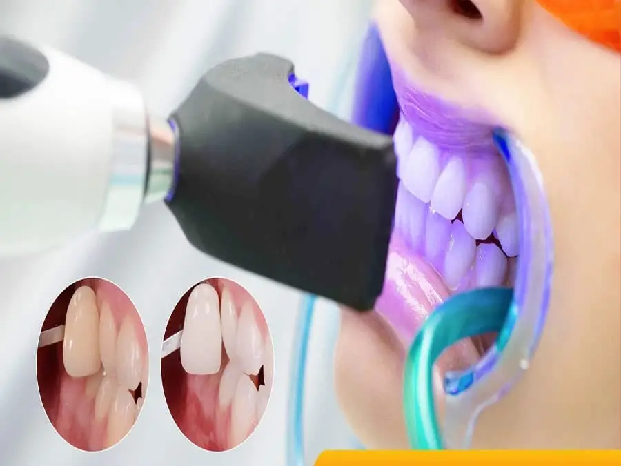 Tẩy Trắng Răng Plasma - Bí Quyết Cho Nụ Cười Rạng Rỡ