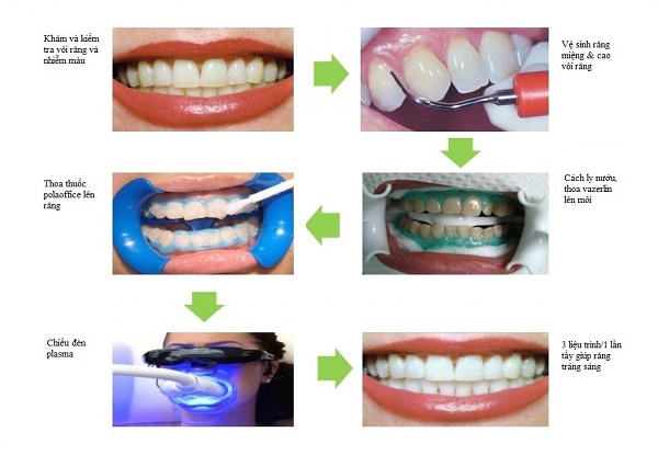 Tẩy Trắng Răng Plasma - Bí Quyết Cho Nụ Cười Rạng Rỡ