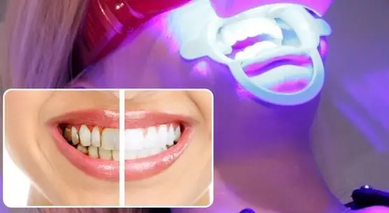 Tẩy Trắng Răng Plasma - Bí Quyết Cho Nụ Cười Rạng Rỡ