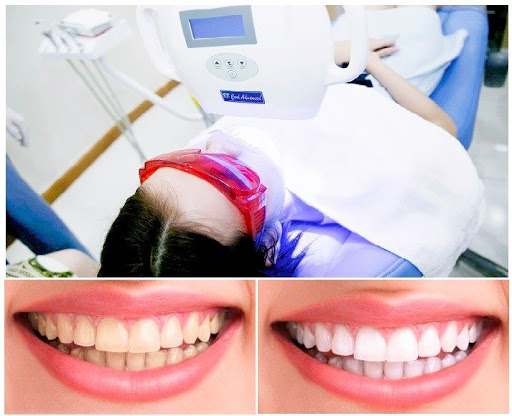 Tẩy Trắng Răng Plasma - Bí Quyết Cho Nụ Cười Rạng Rỡ