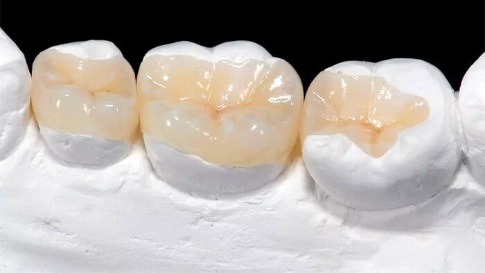 Trám răng có được bảo hiểm không - Tìm hiểu rõ về quyền lợi và chi phí Trám Răng Có Được Bảo Hiểm Không - Tìm Hiểu Rõ Về Quyền Lợi Và Chi Phí