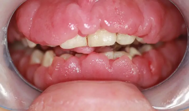 Viêm Lợi Phì Đại - Khi Nụ Cười Bị Che Khuất Bởi Nướu Sưng